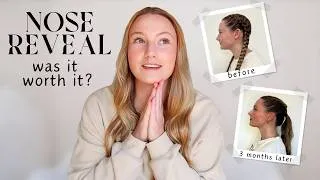 Thumbnail: 3 months after functional rhinoplasty // getting my cast off, how much i paid & was it all worth it?