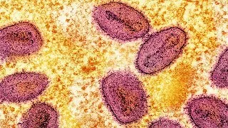 Thumbnail: (Audio-Described Version) Updating NIAID’s Mpox Research Priorities
