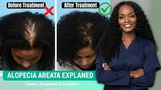 Thumbnail: Alopecia Areata Explained  Causes, Symptoms & Treatment Options #alopeciaareatatreatment