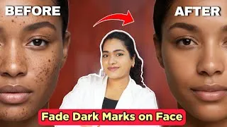 Thumbnail: Fade “Dark Spots” - Effective Treatments, Products, and Skincare Routine