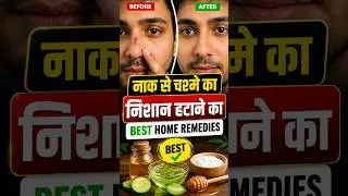 Thumbnail: How to remove Spectacles marks from nose. #homeremedies #eyecaretips