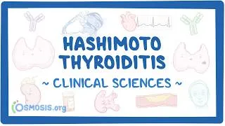 Thumbnail: Hashimoto thyroiditis