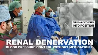 Thumbnail: Renal Denervation - Blood pressure control without medication ?