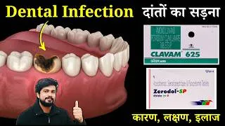 Thumbnail: दांतो का संक्रमण | Dental Infection | Types | Medicine | Treatment | Tooth Decay | Teeth Pain