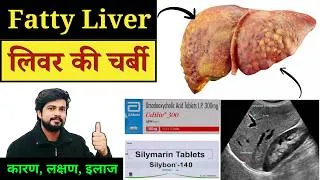 Thumbnail: Fatty Liver | Grade 1, 2 & 3 | Treatment in Hindi | Fatty Liver Ultrasound | फैटी लीवर के Types