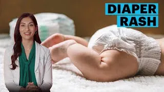 Thumbnail: Diaper Rash Symptoms and Remedies | The Parents Guide | Parents