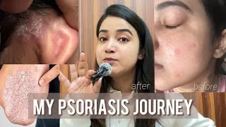 Thumbnail: Psoriasis: My Experience, Triggers & What Helped Me✨