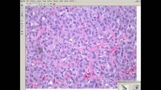 Thumbnail: ENT Pathology  Potpourri of Head %26 Neck Lesions   Slide Seminar w  Dr  Wenig