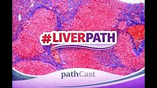 Thumbnail: #LIVERPATH HEPATIC STEATOSIS - slide seminar