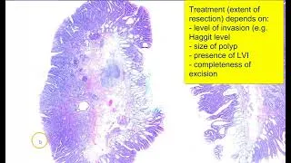 Thumbnail: Colon: Adenocarcinoma in adenomatous polyp with high grade dysplasia (Virtual microscopy)