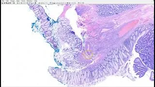 Thumbnail: Colon: Tubular adenoma with low grade dysplasia (Talking slide - virtual microscopy)