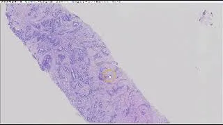 Thumbnail: Breast core biopsy: Invasive carcinoma NST, and distinction from DCIS
