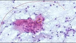 Thumbnail: Thyroid FNA Cytology:  Subacute/DeQuervain/Granulomatous thyroiditis