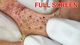 Thumbnail: Blackheads removal - Best Pimple Popping Videos
