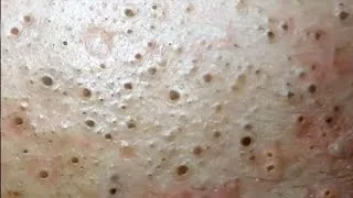 Thumbnail: Multiply Blackheads on Forehead - Blackheads Removal