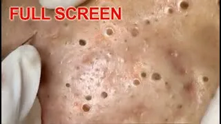 Thumbnail: LARGE Blackheads Removal - Best Pimple Popping Videos
