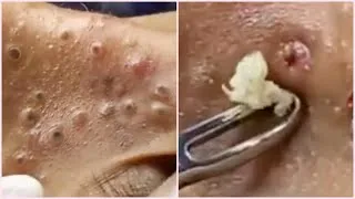 Thumbnail: Blackheads on Nose and Forehead - Best Pimple Popping Videos