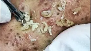 Thumbnail: Big Blackheads Extraction from Cheeks - Best Pimple Popping videos