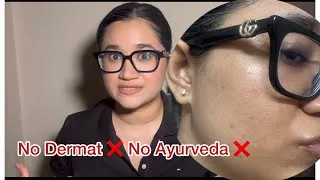 Thumbnail: How I treat my Melasma at Home- jhaiya khatam karne ka tarika