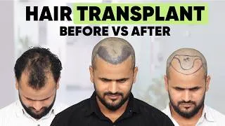 Thumbnail: Hair Transplant in Delhi (HX-SZWS) | Best Results & Cost of Hair Transplant in Delhi