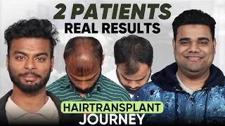 Thumbnail: Hair Transplant in Imphal (HX-ZXCZ) | Best Results & Cost of Hair Transplant in Imphal