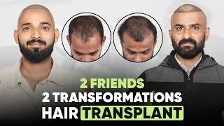 Thumbnail: Hair Transplant in Jaipur (HX-XJJV) | Best Results & Cost of Hair Transplant in Jaipur