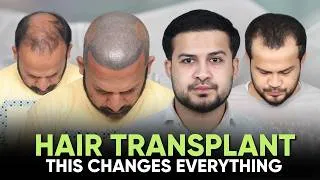 Thumbnail: Hair Transplant in Hoshiarpur (HX-SYZV)  | Best Results & Cost of Hair Transplant in Hoshiarpur