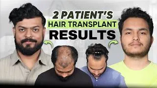 Thumbnail: Hair Transplant in Rourkela (HX-ZTCE) | Best Results & Cost of Hair Transplant in Rourkela