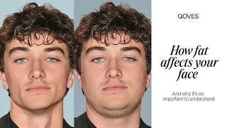 Thumbnail: How Facial Fat Actually Works (And How to Lose It)