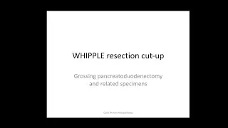 Thumbnail: Grossing/macroscopic examination/cut-up of WHIPPLES and related specimens