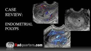 Thumbnail: Ultrasound of Endometrial Polyps