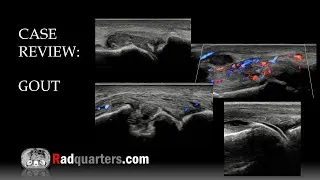 Thumbnail: Ultrasound of Gout