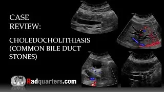 Thumbnail: Ultrasound of Choledocholithiasis (Common Bile Duct Stones)