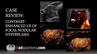 Thumbnail: Contrast-Enhanced Ultrasound of Focal Nodular Hyperplasia