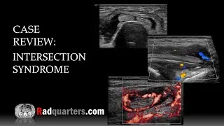 Thumbnail: Ultrasound of Intersection Syndrome