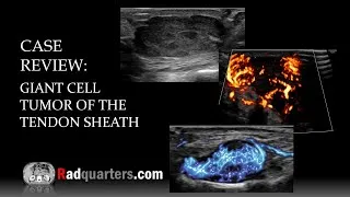 Thumbnail: Ultrasound of Giant Cell Tumor of the Tendon Sheath