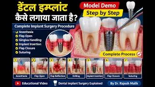 Thumbnail: डेंटल इम्प्लांट कैसे लगाया जाता है? | Model Demo | Step by Step Implant Surgery #drrajeshmalik
