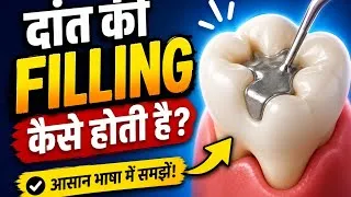 Thumbnail: कैविटी वाले दांत का पूरा इलाज | Cavity Preparation से Composite Filling और Amalgam Replacement