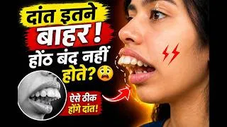 Thumbnail: क्या आपके होंठ बंद नहीं होते? | जानिए Braces कैसे ठीक करते हैं Class 2 केस | टेढ़े दांत + खुले होंठ?