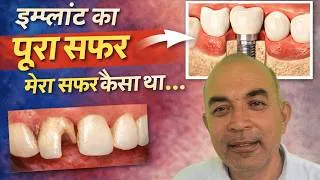 Thumbnail: इम्प्लांट का पूरा सफर | मेरा सफर कैसा था... जानिए इस स्माइल ट्रांसफॉर्मेशन की पूरी कहानी 😊