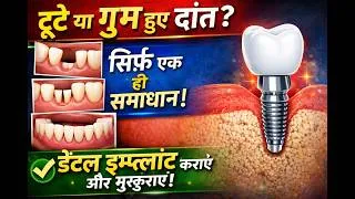 Thumbnail: दांत टूट गया या निकल गया? Dental Implant क्यों जरूरी है जानिए | Dental Implant why Necessary?