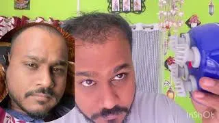 Thumbnail: Live Minoxidil use