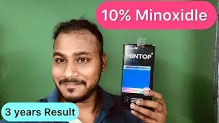 Thumbnail: #Minoxidle 10% | 3 years Results