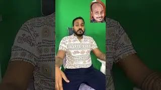 Thumbnail: “Hair Transplant Journey: Before & After Transformation!” #hairtransplantresults