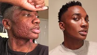 Thumbnail: HOW I GOT PERFECT SKIN (SKINCARE ROUTINE)