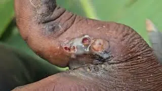 Thumbnail: Lazarus' jigger smothering - BAD ; see long vids @ riseupsociety.net & ruskenya.org