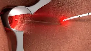 Thumbnail: What is Fistula in Ano? See A Fistula Treatment