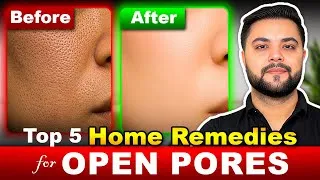 Thumbnail: Top 5 Home Remedies for Open Pores Treatment: Blackheads, Large Pores & Acne Treatment 