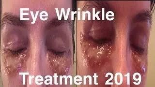 Thumbnail: Laser Eyelid Tigtening with PRP 2019, Anti aging Eye Treatment, How I Fixed My Eye Wrinkles