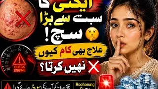 Thumbnail: اگر یہ ویڈیو اسکپ کردی تو پچھتاؤ گے 😱😱😱 اتنا مہنگا علاج پھر بھی ایکنی؟؟؟🤔🧐